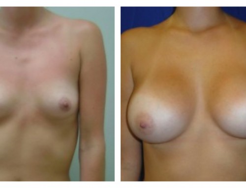 Breast Augmentation Photos